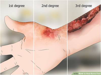Burn treatment Cyprus Limassol Nicosia | Plastic Surgery Cyprus | Plastic  Surgeon Cyprus