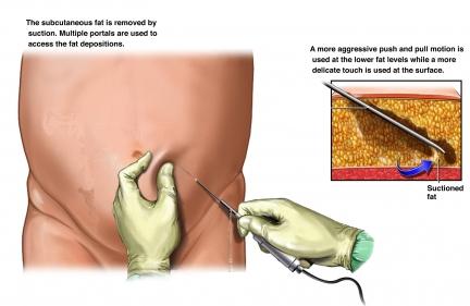 cyprusliposuction.jpg