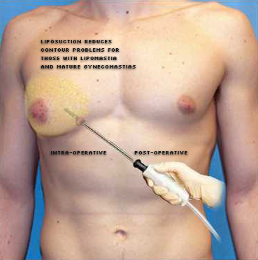 gynecomastia cyprus..png