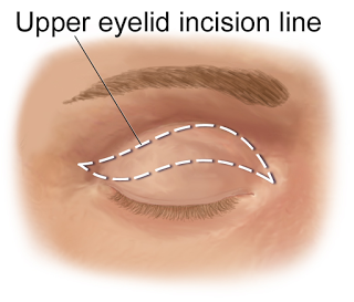 blepharoplasty incision cyprus