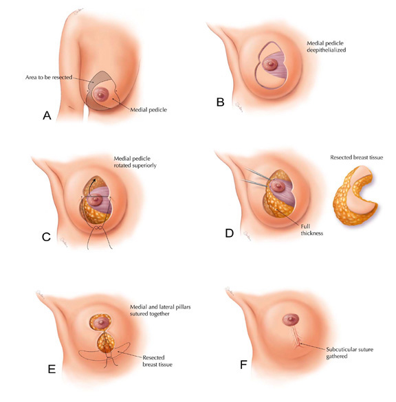 breast reduction cyprus.jpg