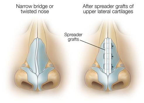 spreadergraft-drraymondgoh.jpg