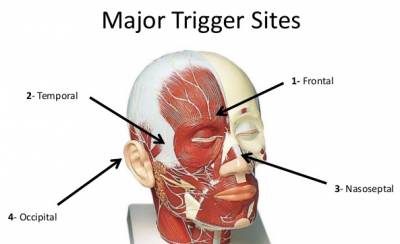 Migraine Surgery