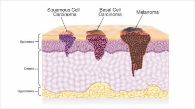 Skin Cancer