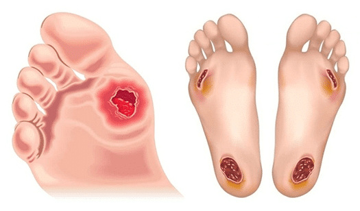 Diabetic-Foot.jpg