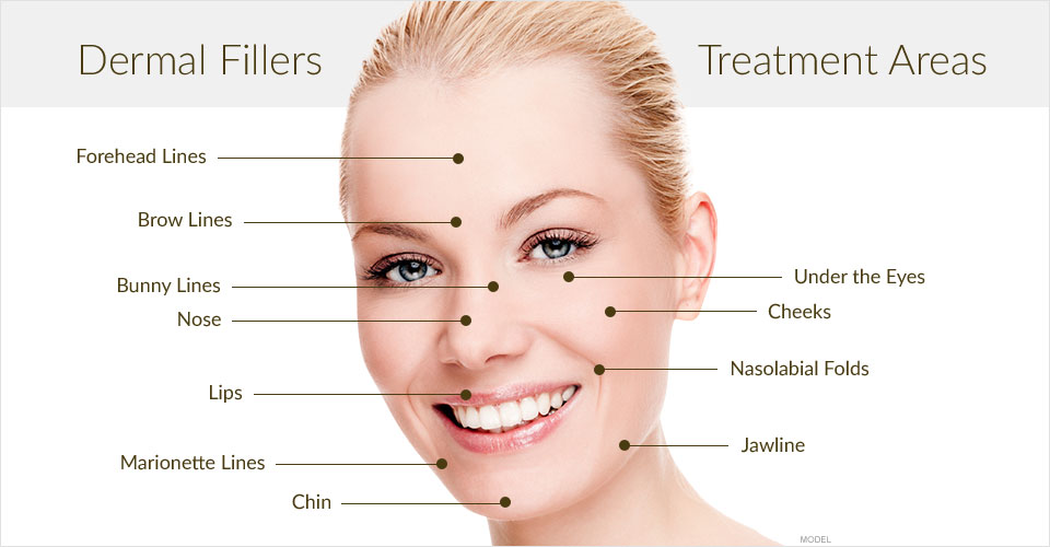 areas of treatment with fillers